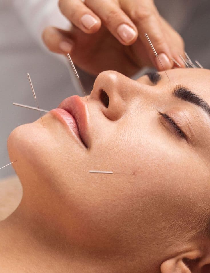 Cosmetic Acupuncture